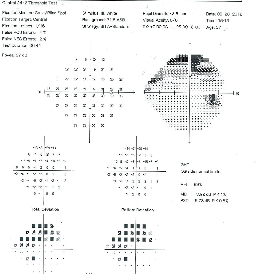 Why Do I Need A Visual Field Test? - Conversations On Eye Health