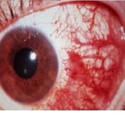 Subconjunctival hemorrhage