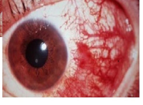 Subconjunctival hemorrhage