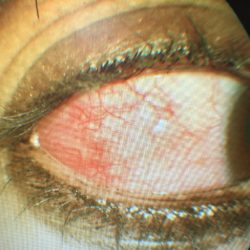 Causes, Treatment, Prevention and Symptoms of Red Eye
