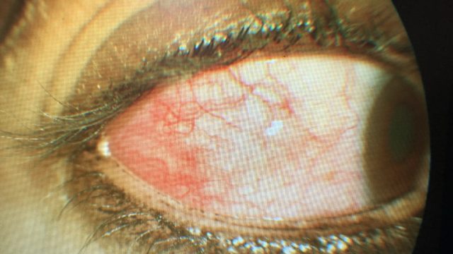 Causes, Treatment, Prevention and Symptoms of Red Eye