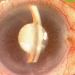 Surgery for Cataract in Glaucoma Patients