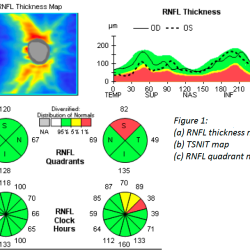 RNFL OCT Glaucoma