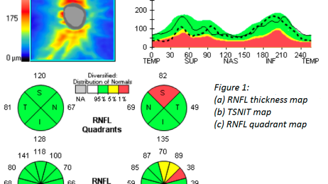 RNFL OCT Glaucoma