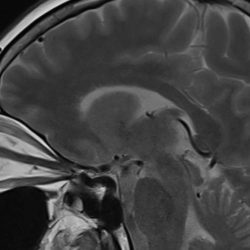 Neurological diseases and eyes