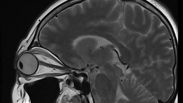 Neurological diseases and eyes