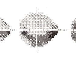 glaucoma may progress despite treatment