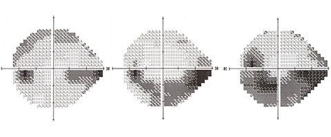 glaucoma may progress despite treatment