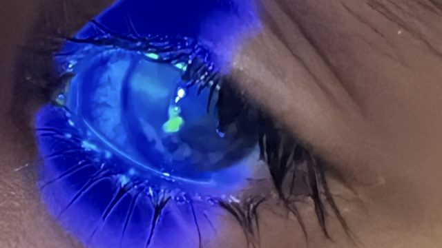 Corneal abrasion, fingernail, paper injury to the eye, flourescein staining on blue light